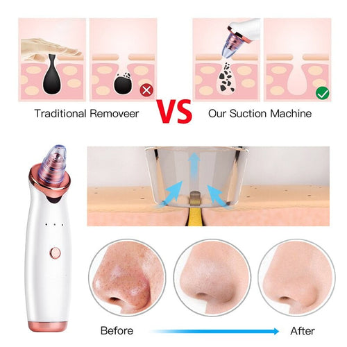 Vacuum Blackhead Remover Pimple Acne Removal Tool Skin Care Pore Pure Faze Health & Beauty